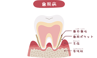 歯周病