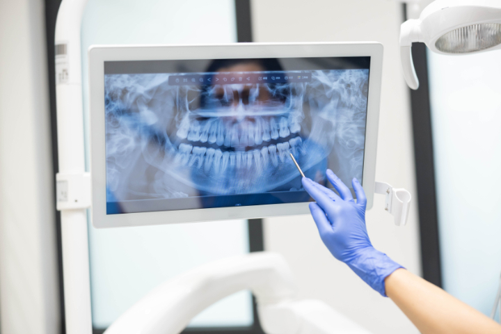 インプラント治療のためのレントゲン検査