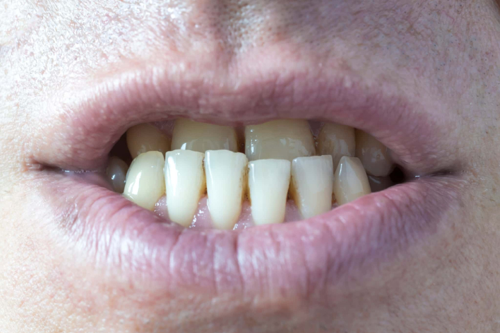 受け口のイメージ