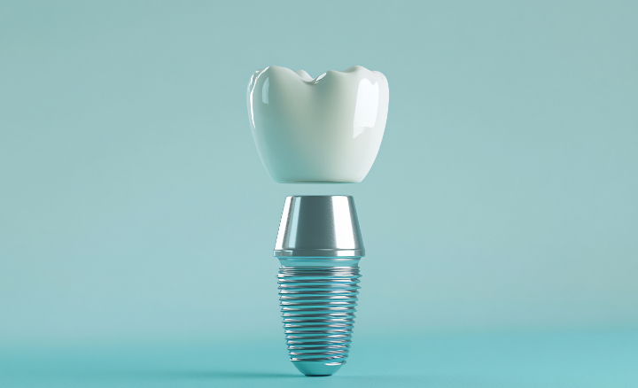 インプラントとは？仕組み・治療の流れ・費用・他治療との違いまで徹底解説