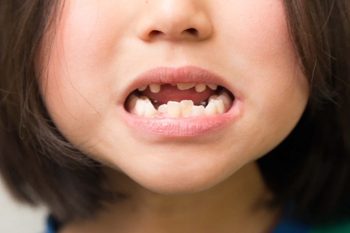 矯正が必要な悪い歯ならびの子ども