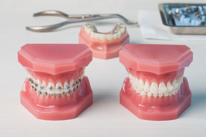 ワイヤー矯正の種類と特徴イメージ