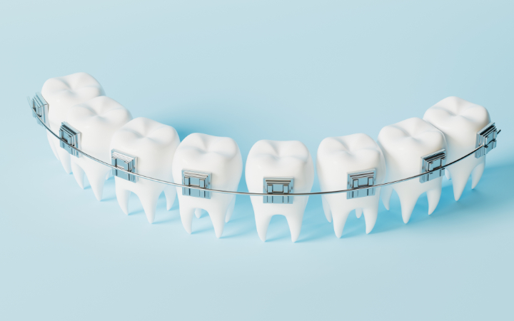 ワイヤー矯正とは？種類・費用・メリットとデメリットまで徹底解説