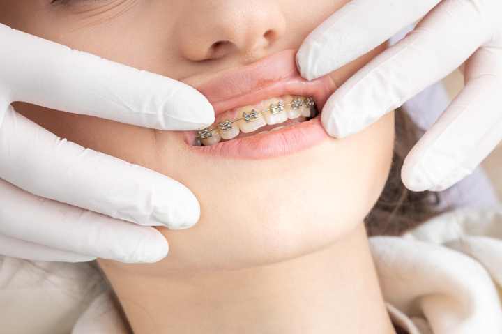 ワイヤー矯正の治療の様子