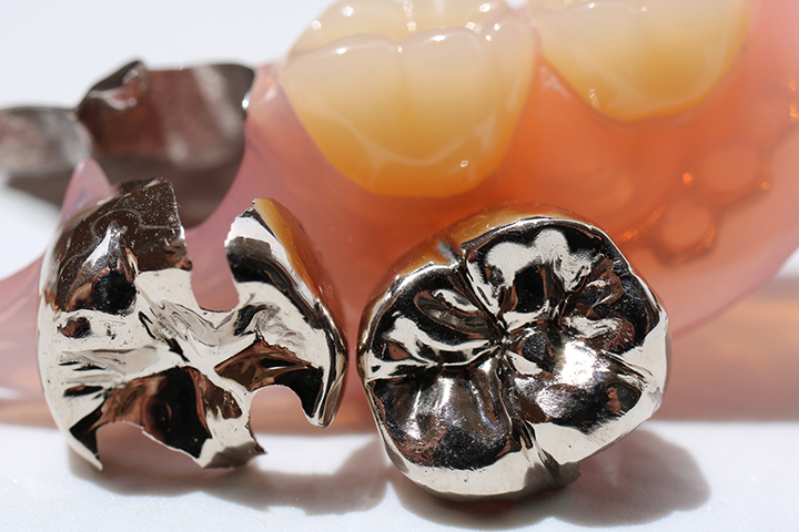 奥歯のつめもの