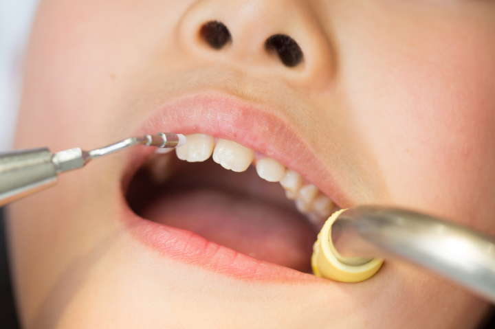 子どもの歯のクリーニングの様子