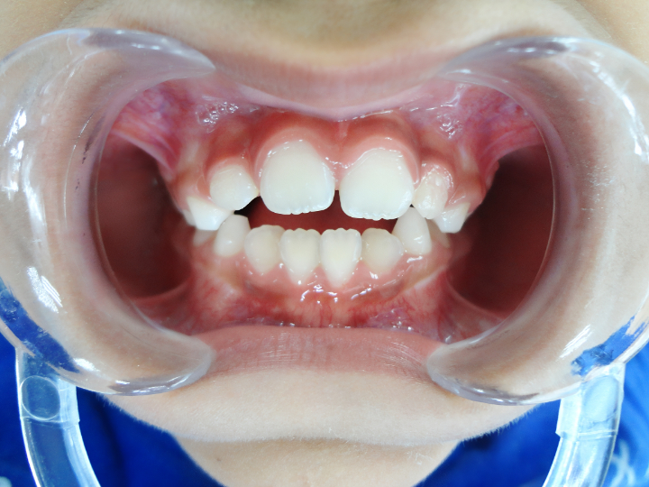 プレオルソの治療前に精密検査をする様子