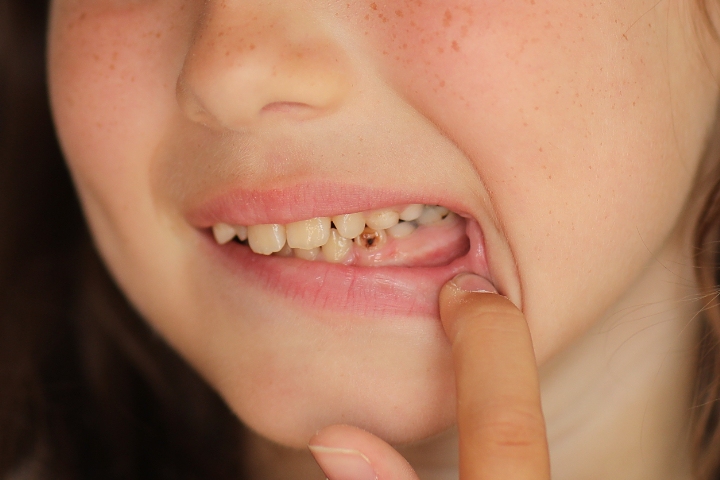 子どもの虫歯のイメージ