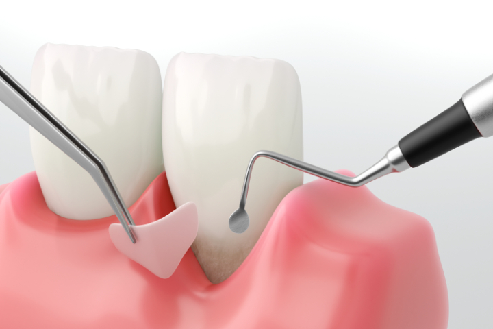 歯周外科治療の様子