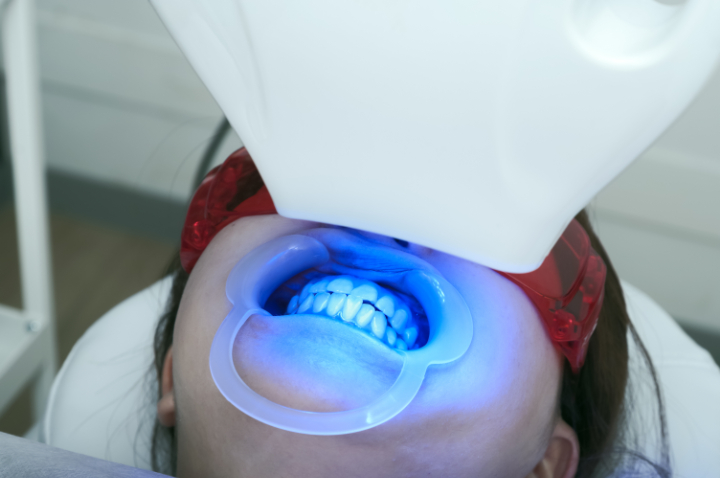 オフィスホワイトニングの様子