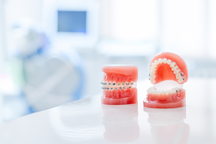 歯科医院に置かれたワイヤー矯正の模型