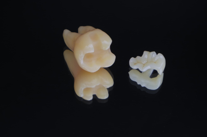 奥歯のセラミックの詰め物