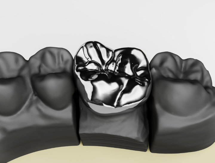 銀歯のクラウンのイメージ