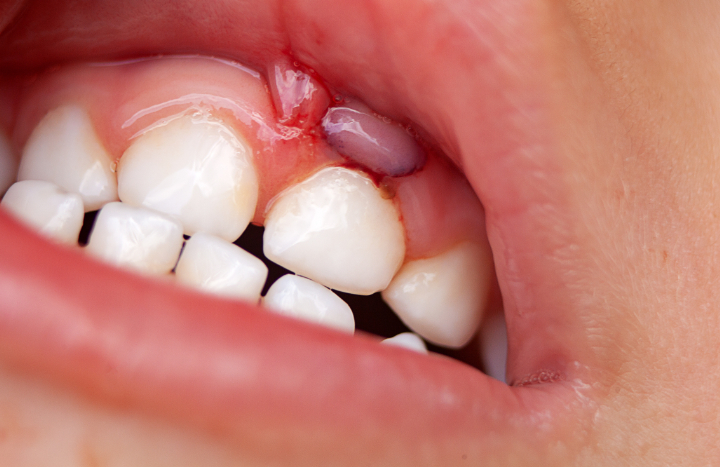 歯肉炎で腫れた歯茎