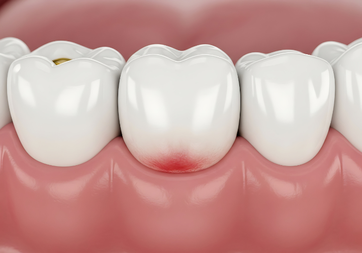 歯肉炎になった口腔内