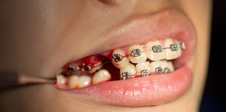 抜歯してワイヤー矯正をしているイメージ