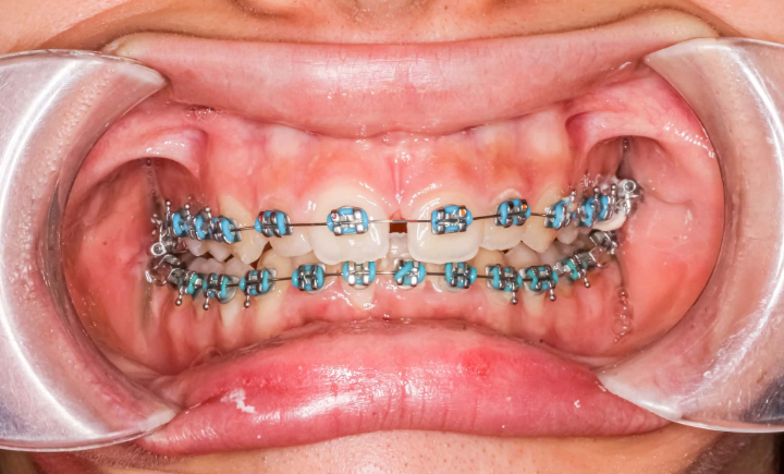 抜歯が不要なすきっ歯のワイヤー矯正