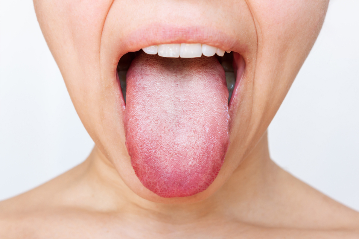 歯周病以外に考えられる口臭の原因としてあげられる舌苔(ぜったい)