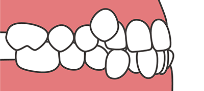 凹凸のある歯並びのイラスト