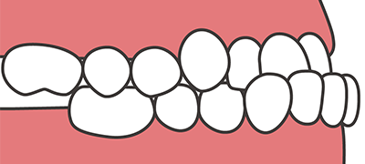 受け口のイラスト