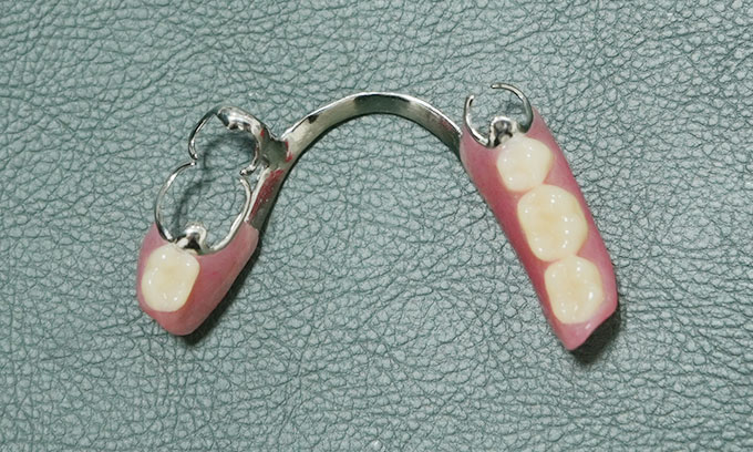 アクリルデンチャー