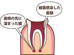 根管治療の流れ