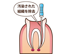 根管治療の流れ