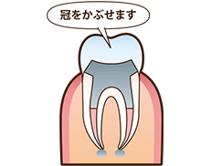 根管治療の流れ