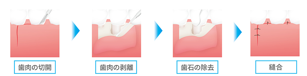 歯周再生療法の例