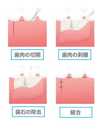 歯周再生療法の例