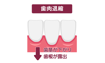 歯ぎしり・食いしばり